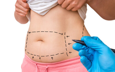 How Much is Liposuction in Tijuana?